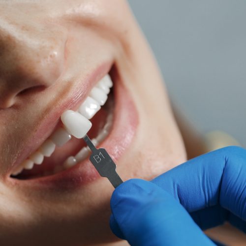 dentist-whiting-teeth