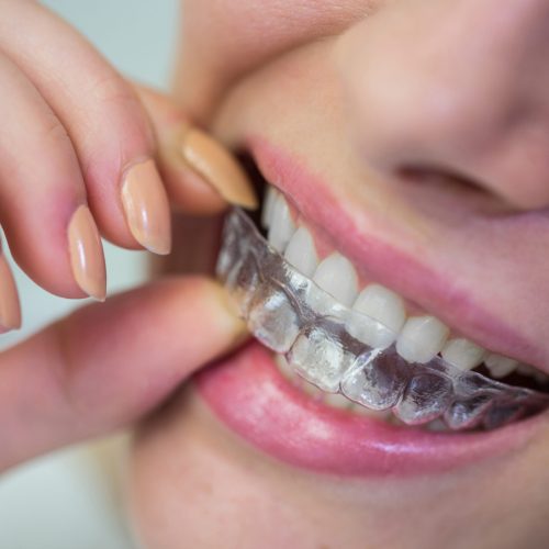 Close-up of woman wearing orthodontic silicone invisible braces